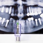 smilesrforever-implant-dentistry